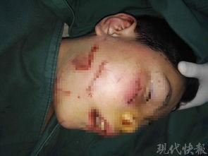 砍伤的伤口能否吃瓜