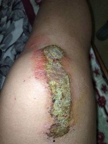 砍伤的伤口能否吃瓜